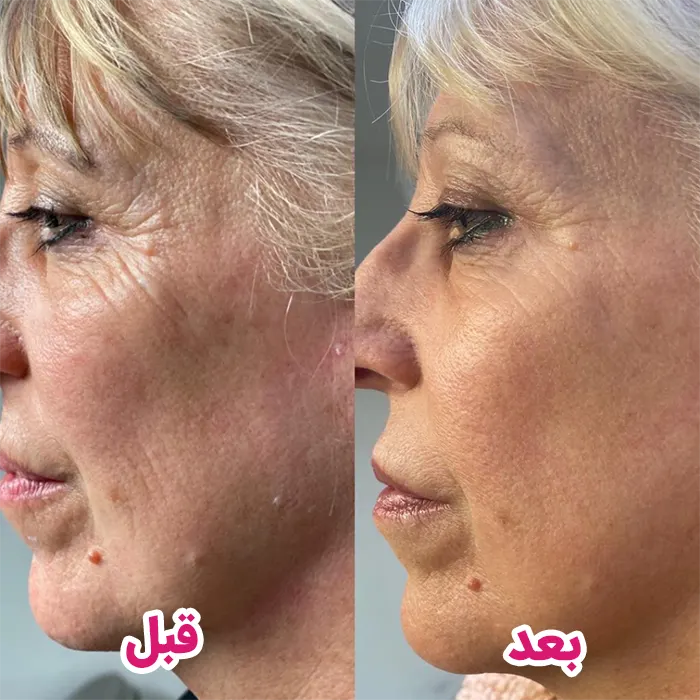 بهترین مزوژل و جوانساز پوست کدام است؟