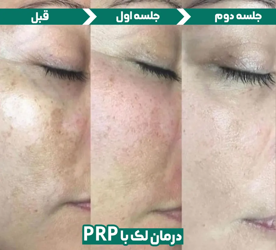 فواید تزریق پی ار پی (prp)صورت چیست؟